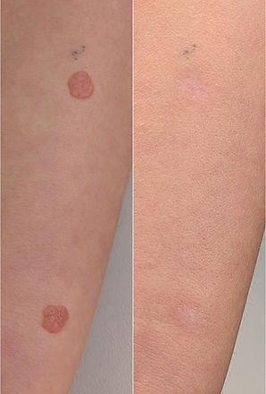 Wart Removal Brighton - Jemma Jarman