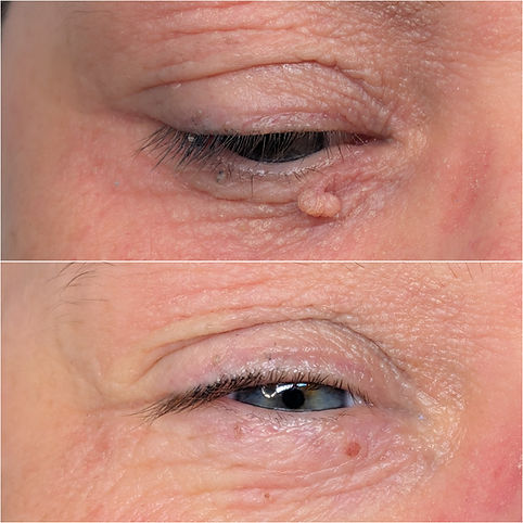 Skin tag removal eye - Brighton