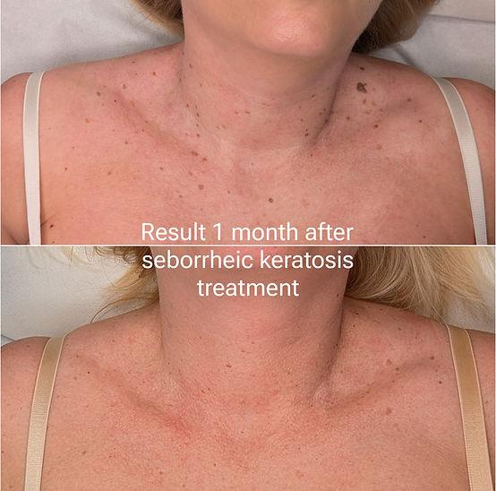 Seborrheic keratosis removal - Brighton by Jemma Jarman