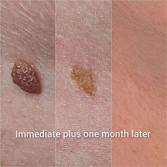 Mole removal Brighton - Jemma Jarman