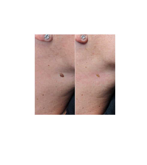 Mole removal Brighton by Jemma Jarman