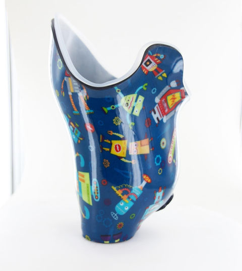 Pediatric Transfemoral Prosthetic Socket
