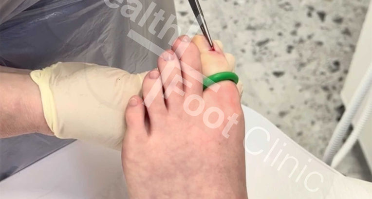 The ingrown portion of the nail, along with any excess tissue (such as hypergranulation), is removed.