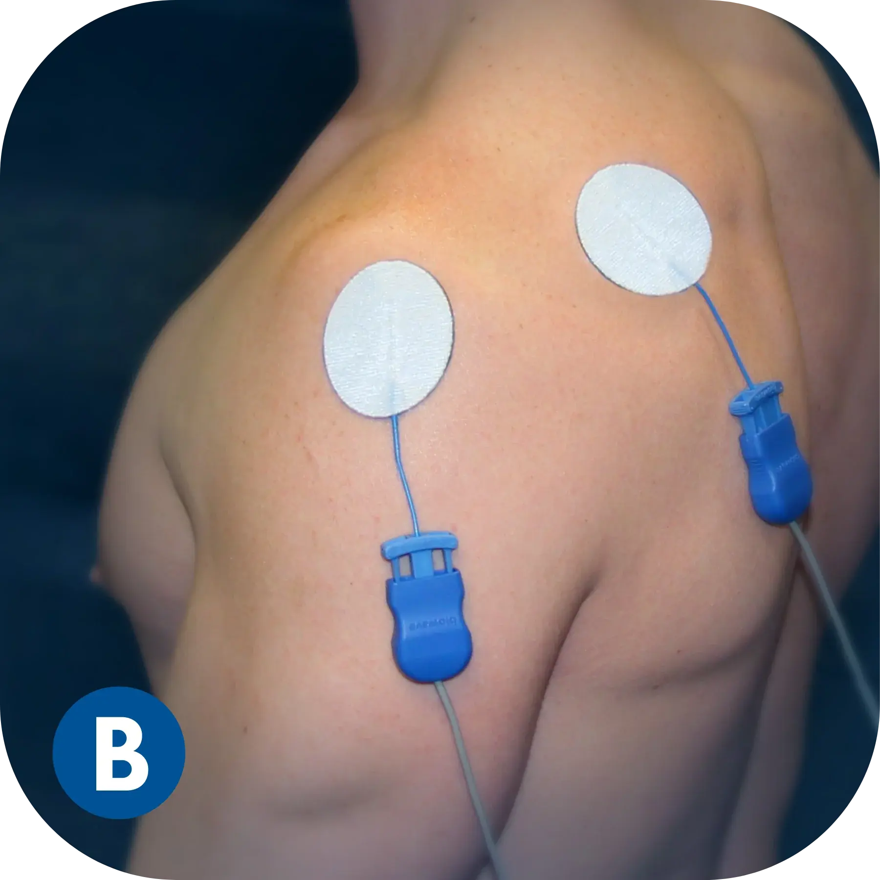 Single Session of Biowave Nerve Pain Blocking - Shoulder (30 Min)