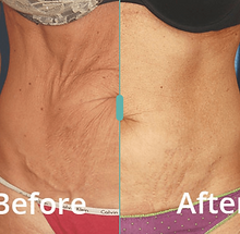 Skin Tightening.png