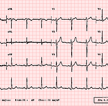 EKG.png