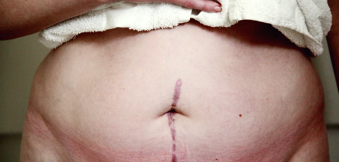MLD for surgery recovery in De Pere, WI.webp