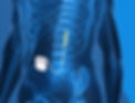 Spinal-Cord-Stimulation-Pain-Management-in-Ahmedabad_edited.jpg