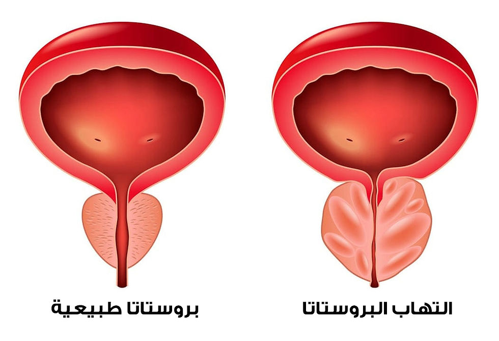 رسم توضيحي للمقارنة بين بروستاتا طبيعية وملتهبة، بلون وردي، خلفية بيضاء، مع نص بالعربية يوضح الحالة في الأسفل.
