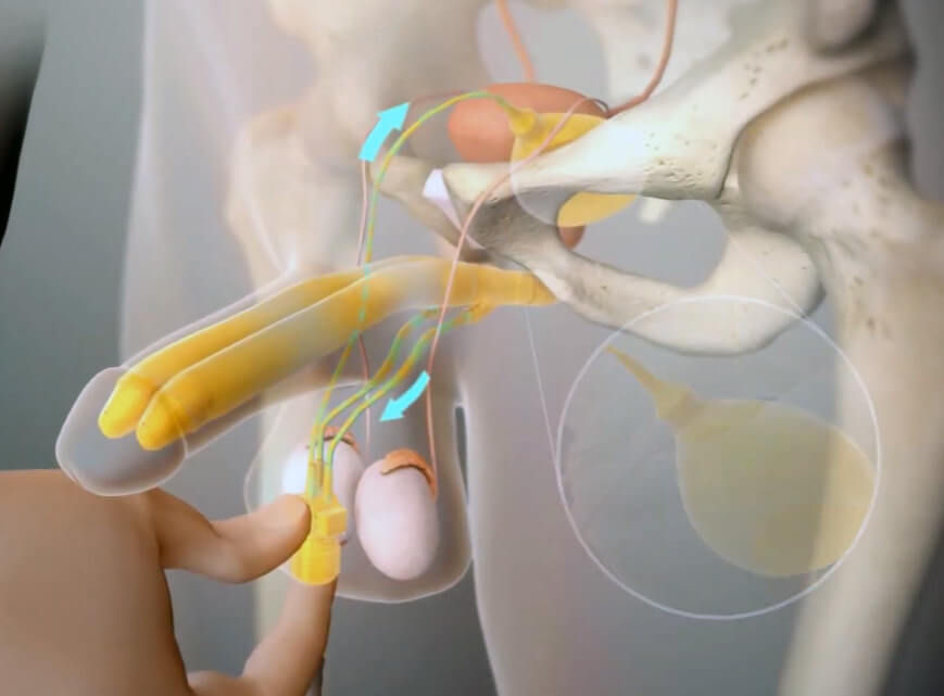 هل أحتاج إلى دعامة ذكرية؟ 5 علامات واضحة لا يجب تجاهلها