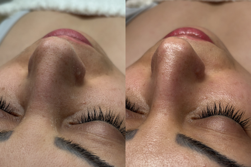 Clogged pores extraction before and after results clear skin facial New Westminster