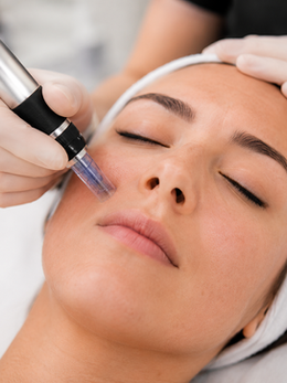 Microneedling for Acne Scars: Does It Really Work?