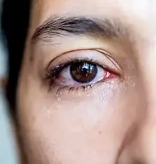 mulher com olhos vermelhos