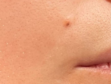 The Controversy of Tattooing Over Scars and Moles: When is it Safe?