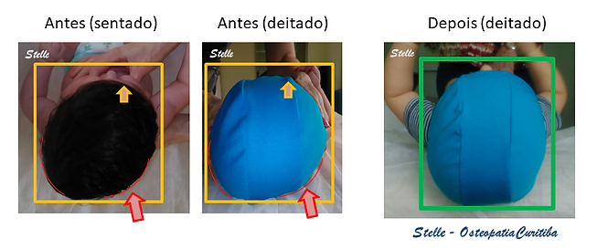Foto após 10 sessões de osteopatia - crânio bebê