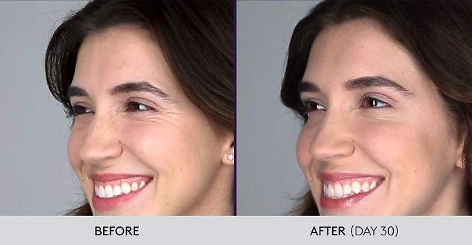 woman smiling after receiving Botox treatment