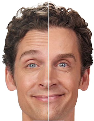 forehead lines shown on man before and after Botox