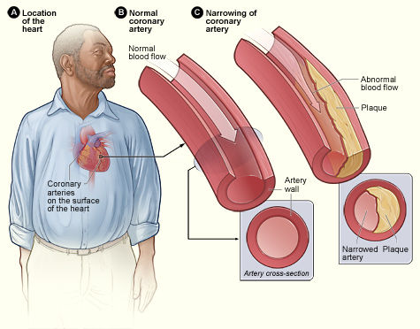 Atherosclerosis Plaque