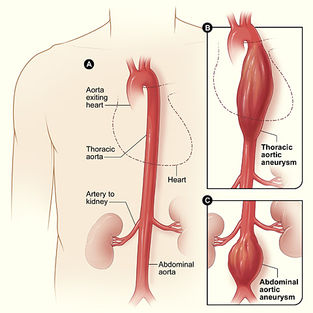 Aortic Aneurysms In Simple Terms