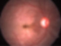 central-retinal-artery-occlusion image