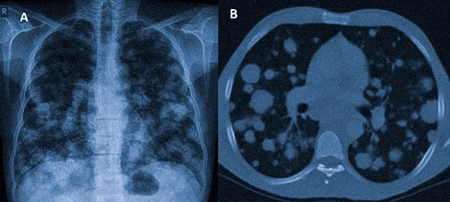 на снимках: множественные метастазы в легких