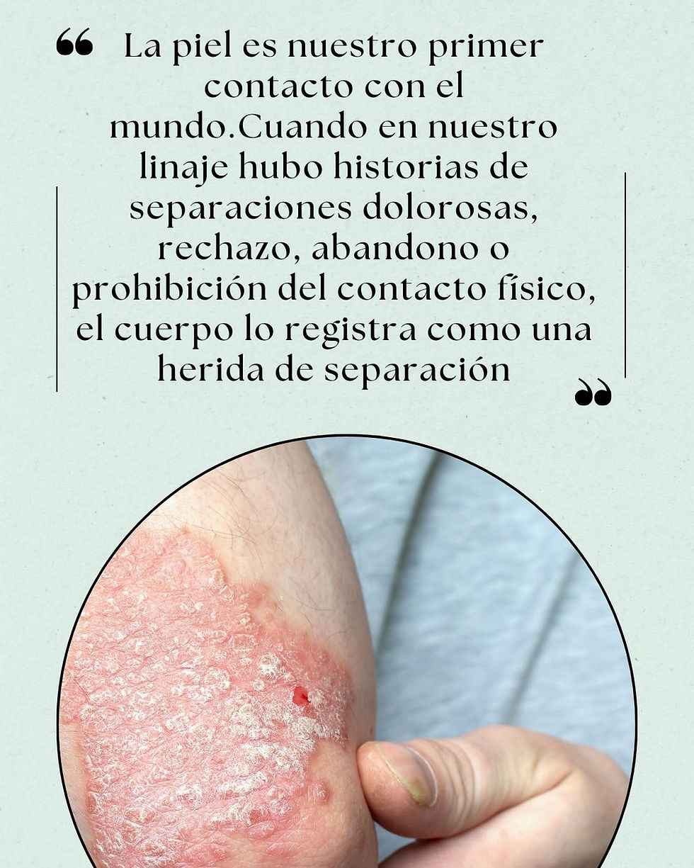Psoriasis Humano Puente