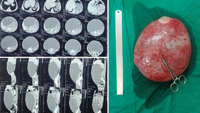 Huge Mesenteric Cyst in a 7 years old boy