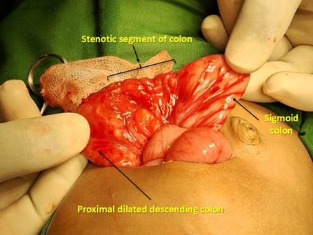 Congenital Colonic Stenosis