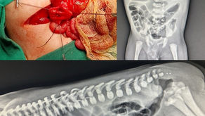 Duodenal Atresia with Anorectal Malformation.