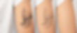 MedGalore Aesthetics & Wellness Before and after laser tattoo removal procedures, closeup.jpg