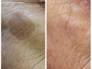 Skin Tag, Sun Spot & Benign Lesion Removal in Manchester