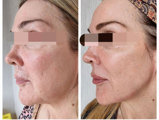 Full Facial Contouring: Why Treating the Whole Face Creates the Most Natural Lift
