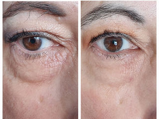 The best ways to treat lines and wrinkles without Botox (Best treatments for Forehead lines, Frown Lines & Crow’s Feet)