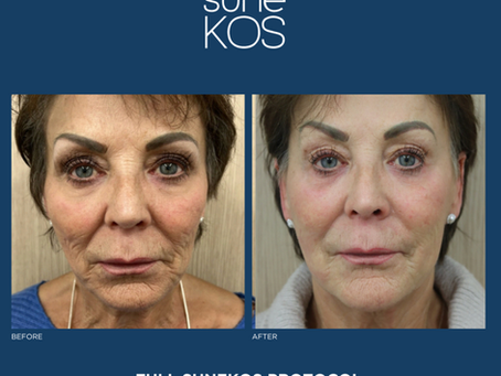 Sunekos Treatment Explained: Benefits for Under Eyes, Neck Lines, Skin Laxity and Collagen Banking