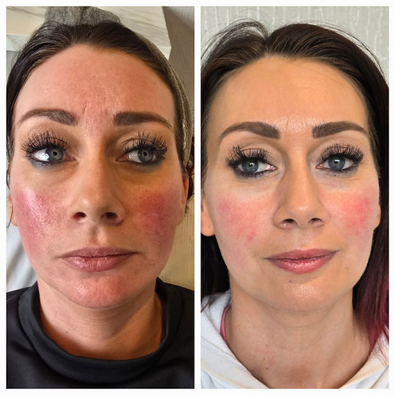 does glutathione help rosacea How to Treat Winter Skin Inflammation: The Best Treatments for Rosacea, Sensitivity & Acne does glutathione help rosacea How to Treat Winter Skin Inflammation: The Best Treatments for Rosacea, Sensitivity & Acne