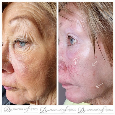 facial before and after