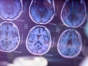 O mercado global de Alzheimer em transformação: inovações e impactos no Brasil