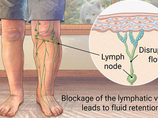 "First I have cancer and now I have Lymphedema?"