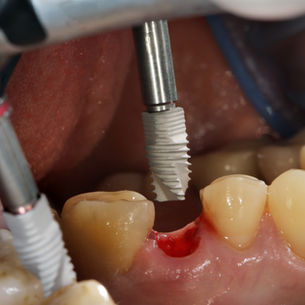İmplant Nedir? İmplant Tedavisi | Sakarya Diş Hekimi Prof. Dr. Hasan Oruçoğlu