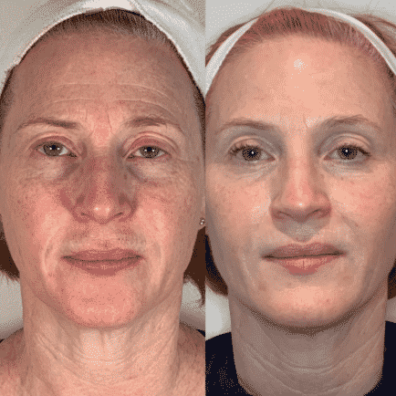 Radiofrequency Microneedling by Craft Skin Clinic in Waite Park, MN