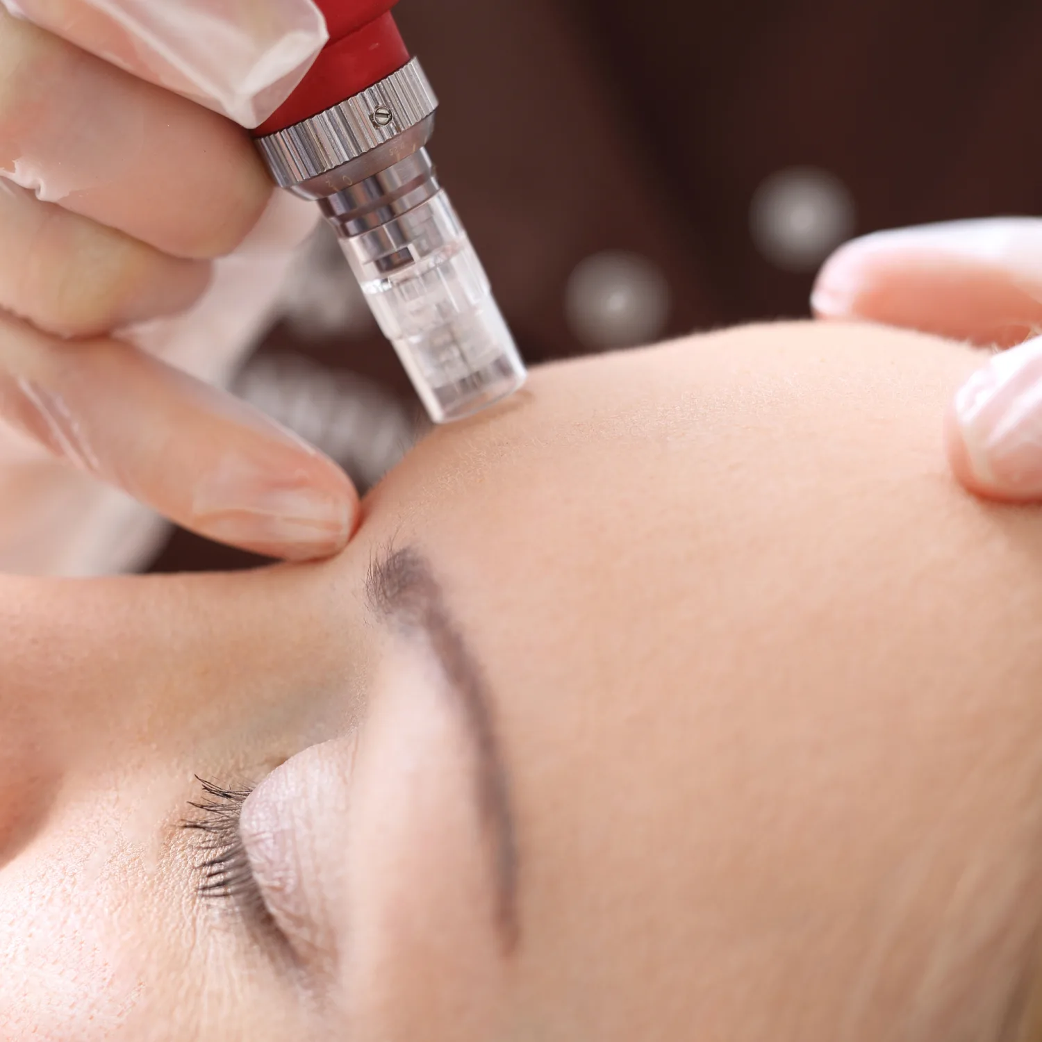 Microneedling by Craft Skin Clinic in Waite Park, MN