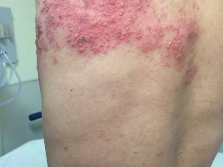TO DO - Post-herpetic neuralgia