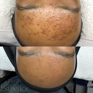 skin by devyn, esthetician, aesthetician near me, estheticians near me, medical esthetician, licensed esthetician, skincare, skin care products, best skin care products, skincare clinic, acne treatment, best skin care for aging skin, esthetician maple grove, maple grove esthetician, esthetician twin cities, aesthetician maple grove
