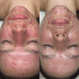 skin by devyn, esthetician, aesthetician near me, estheticians near me, medical esthetician, licensed esthetician, skincare, skin care products, best skin care products, skincare clinic, acne treatment, best skin care for aging skin, esthetician maple grove, maple grove esthetician, esthetician twin cities, aesthetician maple grove
