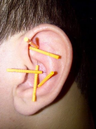 Auricular Acupuncture