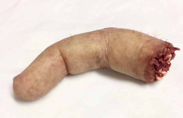 Severed Finger