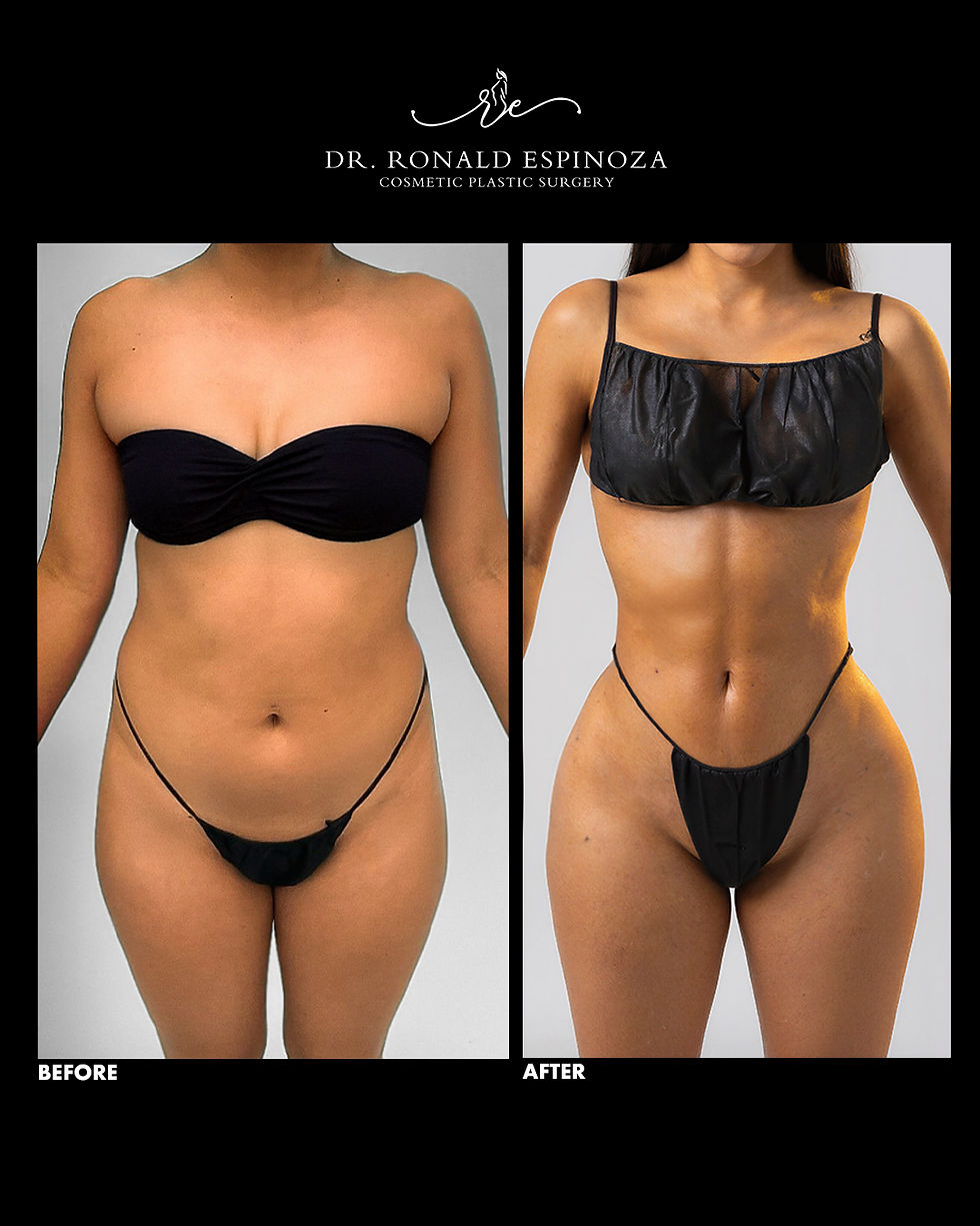 Before and after image of a female patient showing results from high-definition liposuction and Brazilian Butt Lift (BBL) by Dr. Ronald Espinoza, highlighting a slimmer waist, sculpted abs, and fuller, lifted buttocks.
