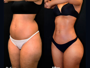 How to Get Rid of FUPA: Your Complete Guide to a Flatter Lower Abdomen