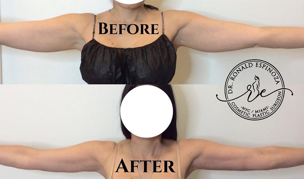 Before and after photo of a female patient showing arm lift results by Dr. Ronald Espinoza, highlighting smoother and firmer upper arms.