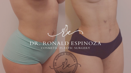 Before and after results of FUPA treatment by Dr. Ronald Espinoza showing a smoother lower abdomen in female patients